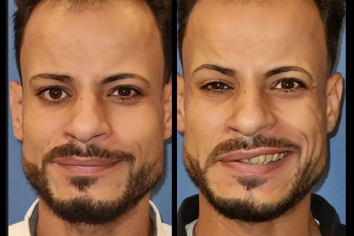 شلل نصفي للوجه