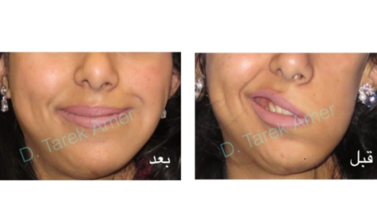 Amer Center for Facial Nerve Treatment – Expert Care for Facial Paralysis