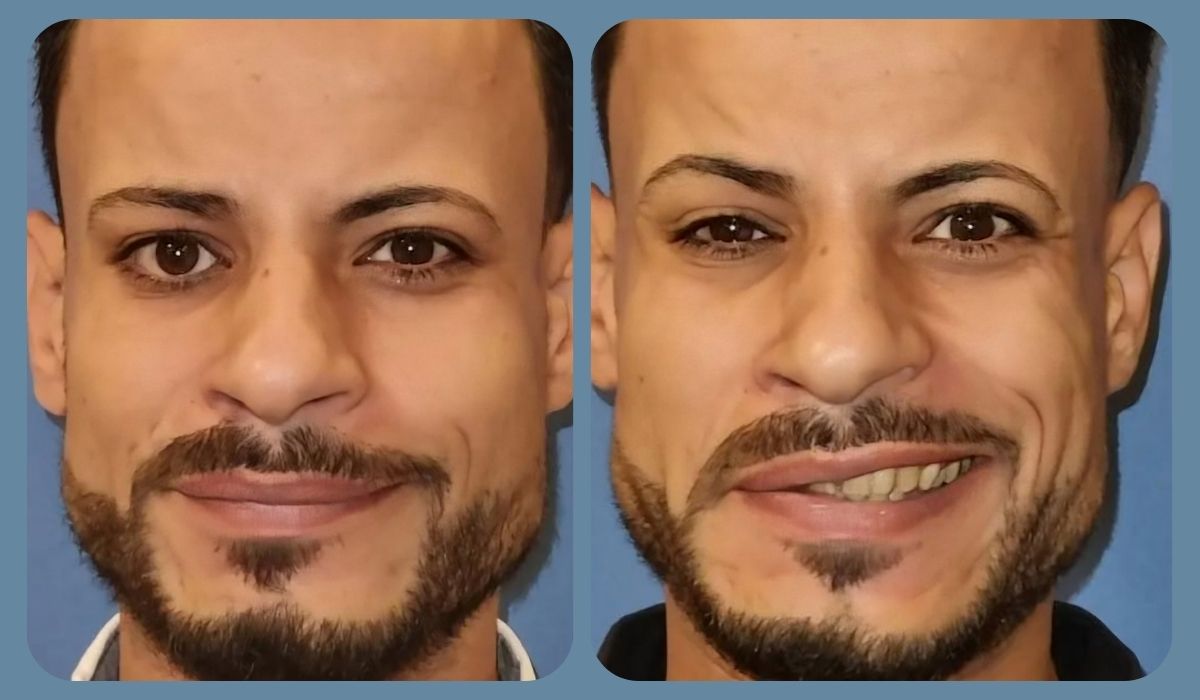 Illustration showing symptoms of facial synkinesis such as involuntary facial movements, guided by Dr. Tarek Amer at Amer Facial Paralysis Center